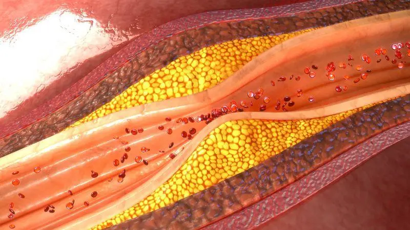 風(fēng)口 | 冠脈鈣化“終結(jié)者”——血管內(nèi)沖擊波