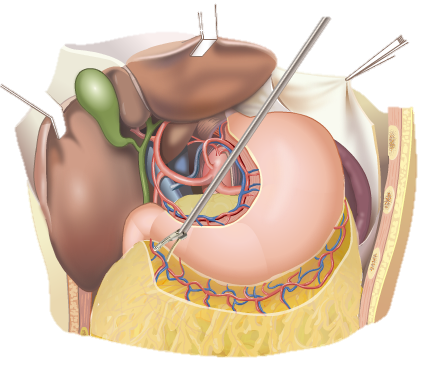 前研 | 外科止血超聲刀類產(chǎn)品臨床及注冊(cè)
